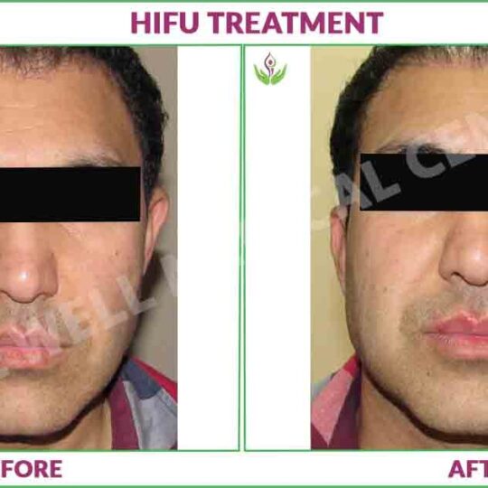 Hifu treatment before and after result photo