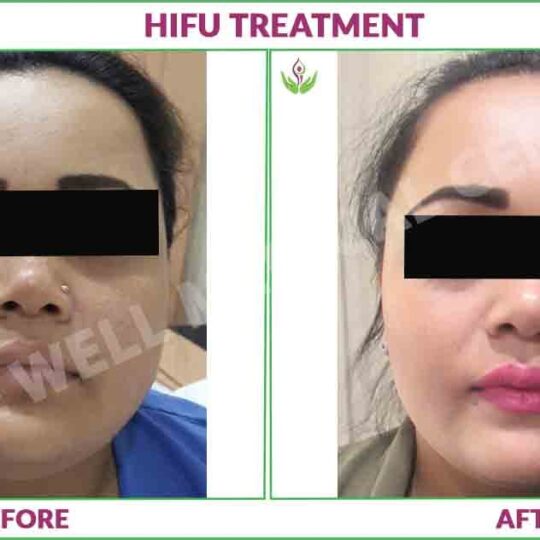 Hifu treatment before and after photo