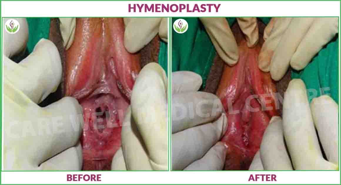 hymenoplasty before and after photos