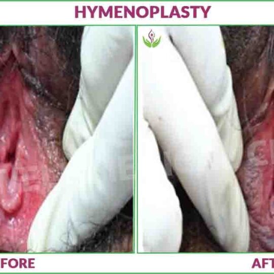 hymenoplasty before and after photo in Delhi