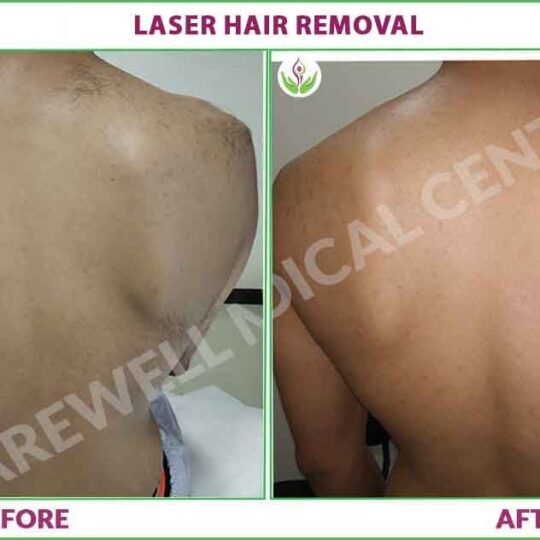 laser hair removal before and after results image