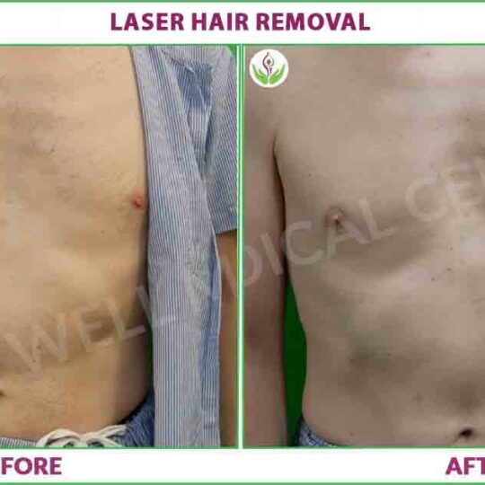 laser hair removal before and after results photo