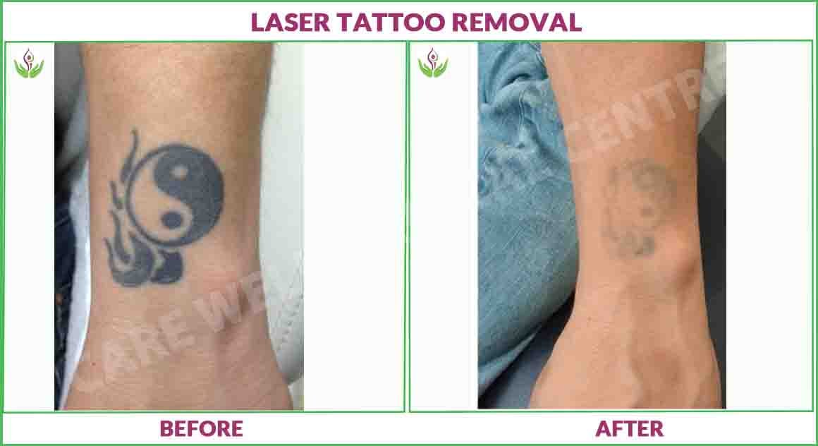 laser tattoo removal before and after photo