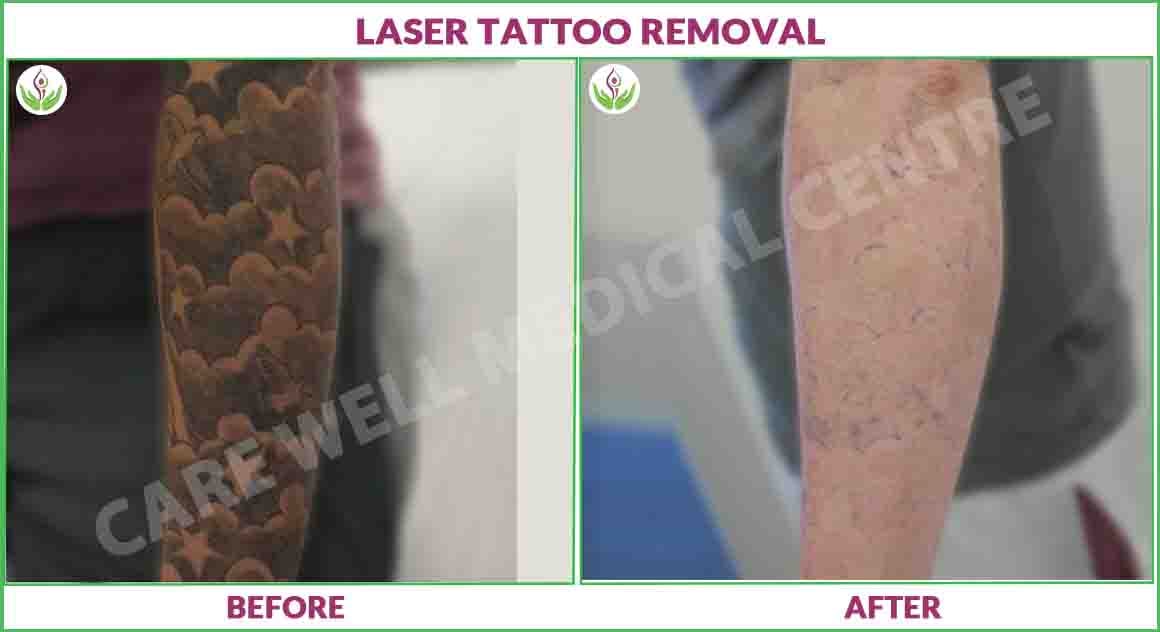 laser tattoo removal before and after photo