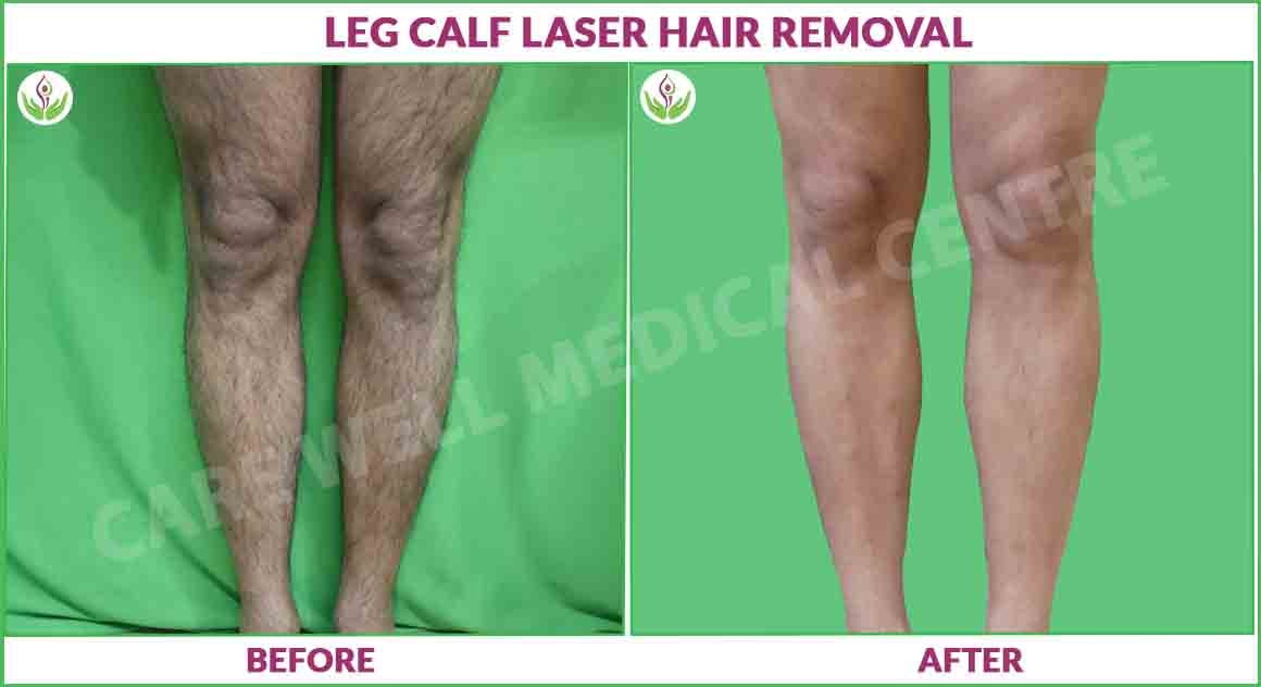 leg and calf laser hair removal before and after result