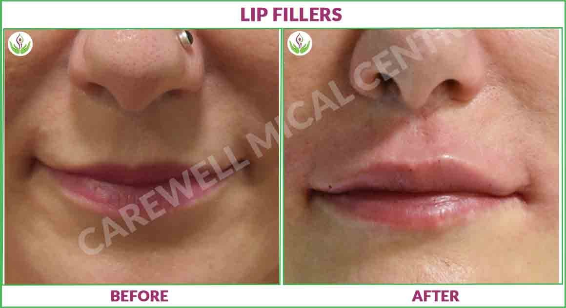 lip fillers before and after photo 1