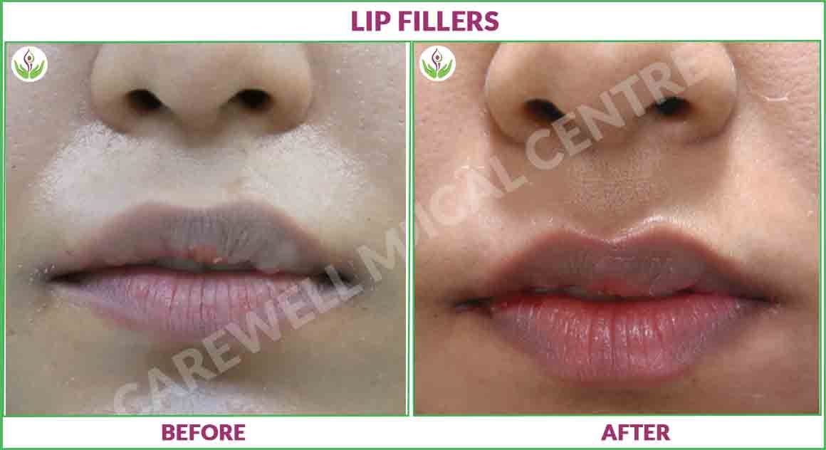 lip fillers before and after photo