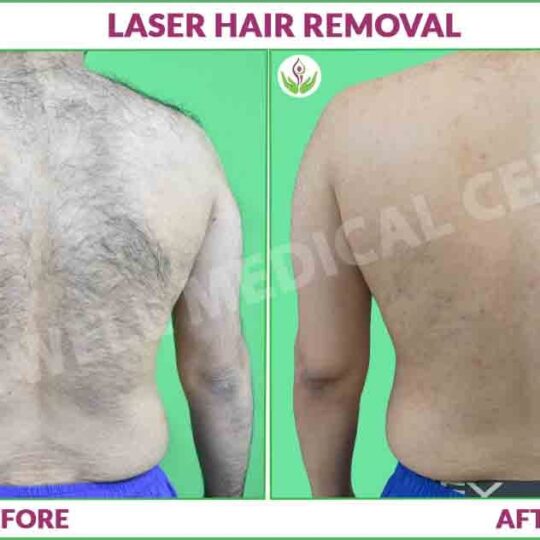 male back laser hair removal before and after photo