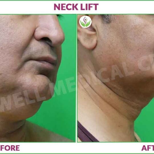 necklift before and after image