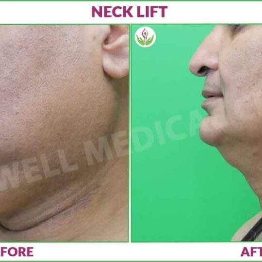 necklift before and after photo