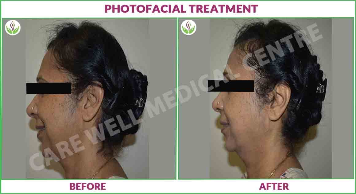 photofacial treatment before and after photo