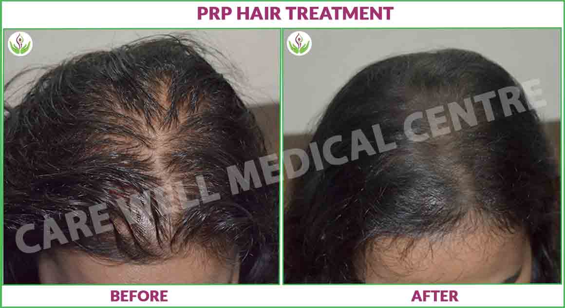 prp hair treatment before and after photo 1