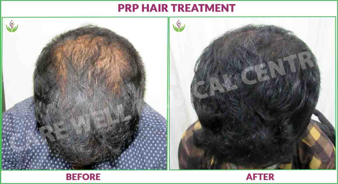 prp hair treatment before and after photo