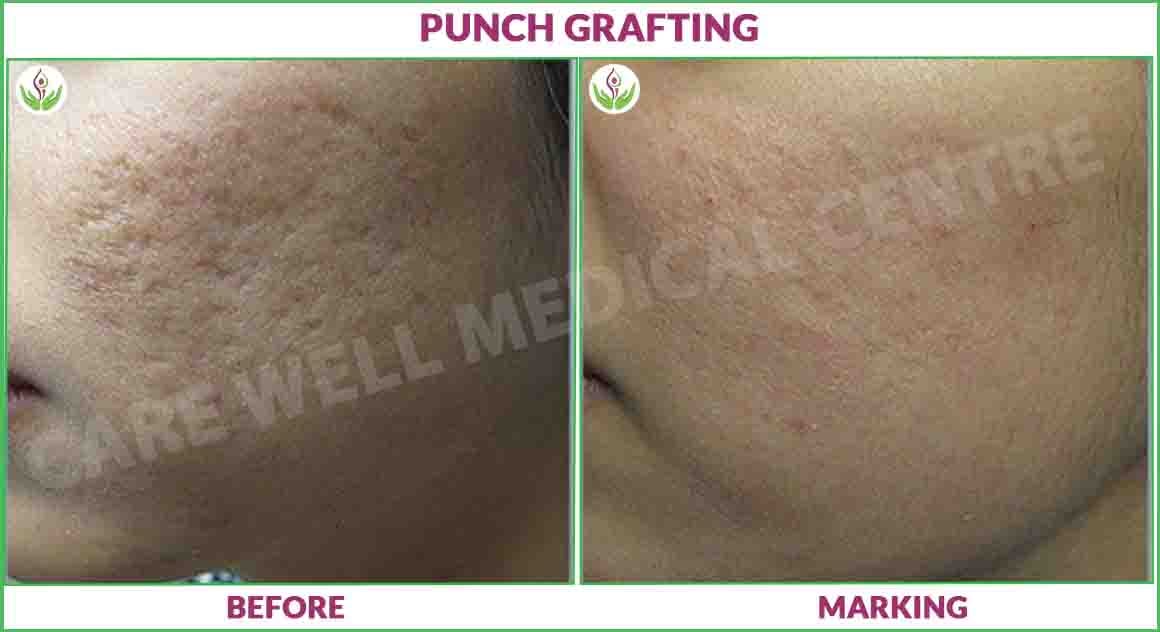 punch grafting before and after photo