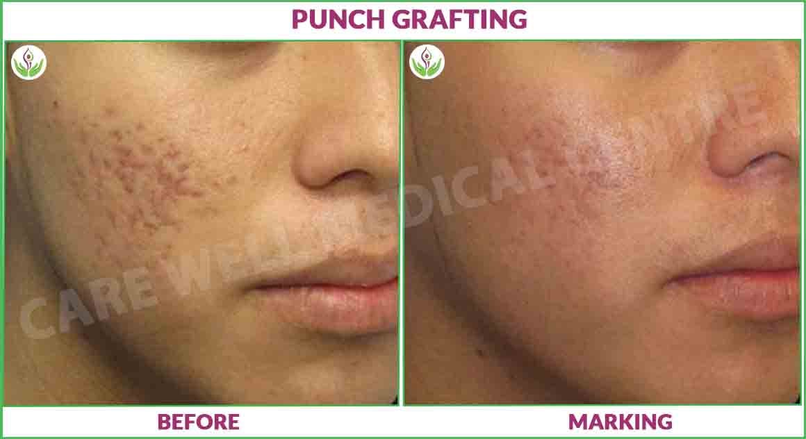 punch grafting before and after photo