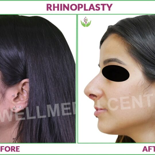 rhinoplasty before and after photo