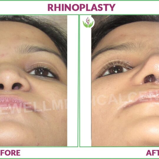 Rhinoplasty before and after pictures Delhi