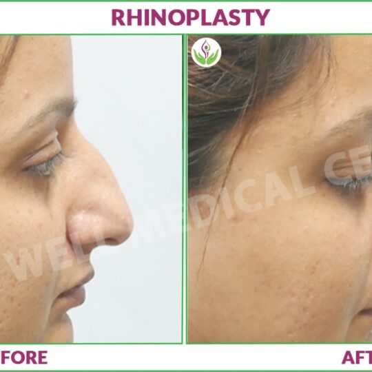 rhinoplasty before and after photo