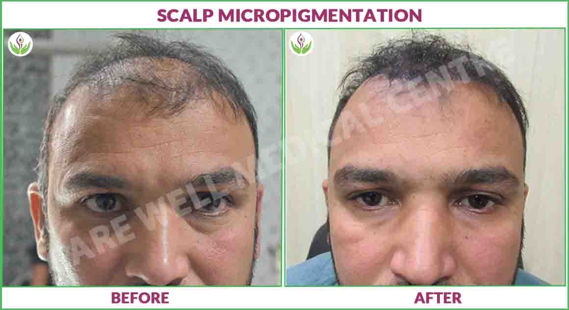 scalp micropigmentation before and after Result