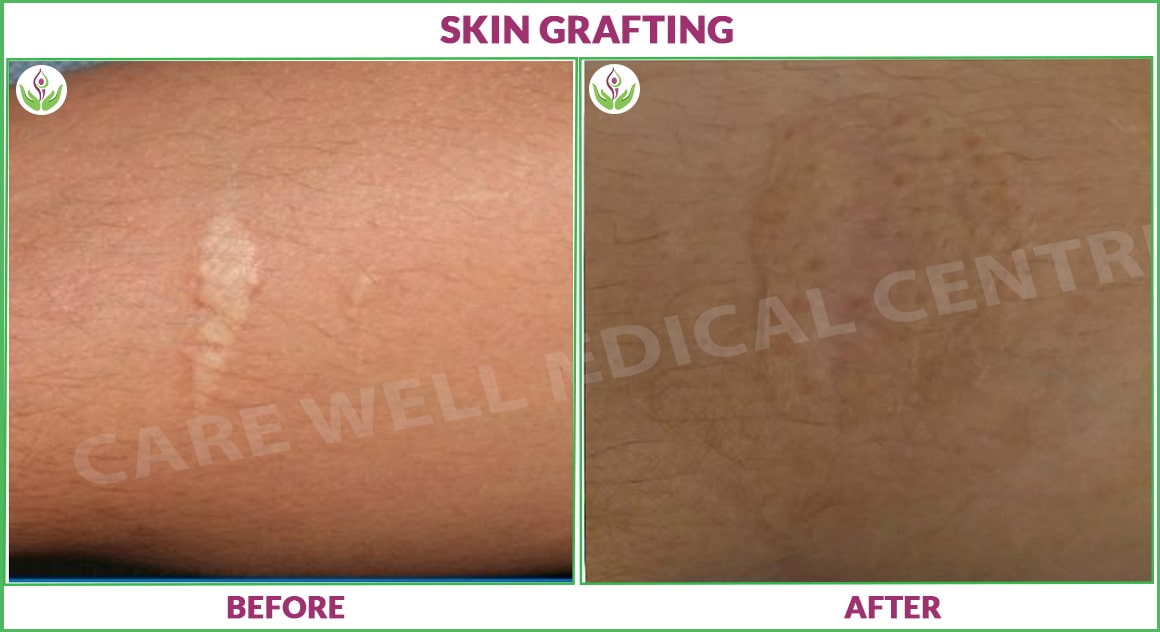 skin grafting before and after photo