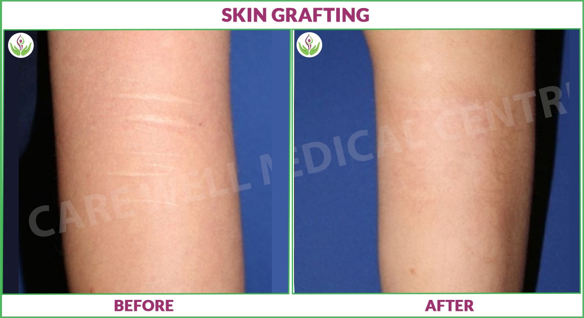 skin grafting before and after photo