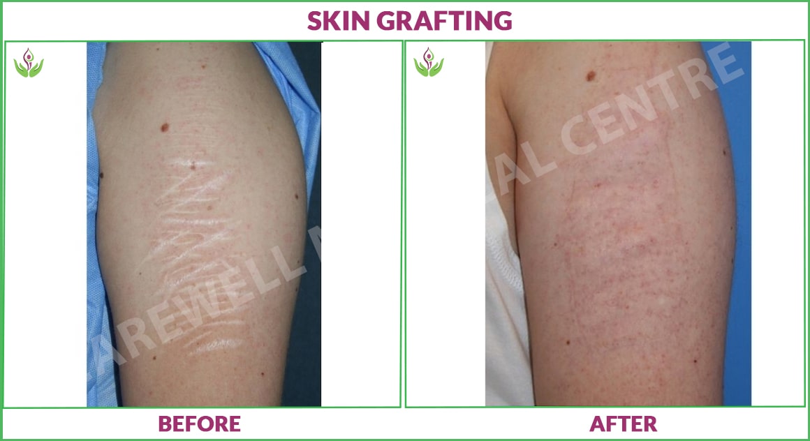 skin grafting before and after photo