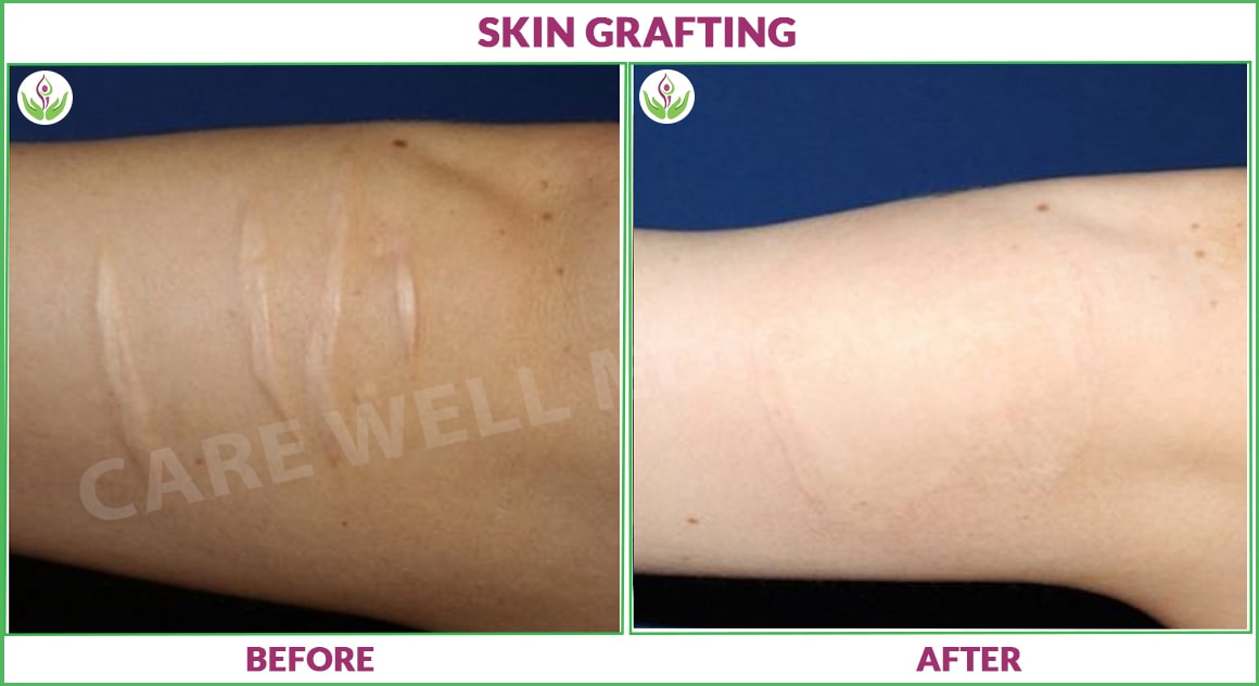 skin grafting before and after photo