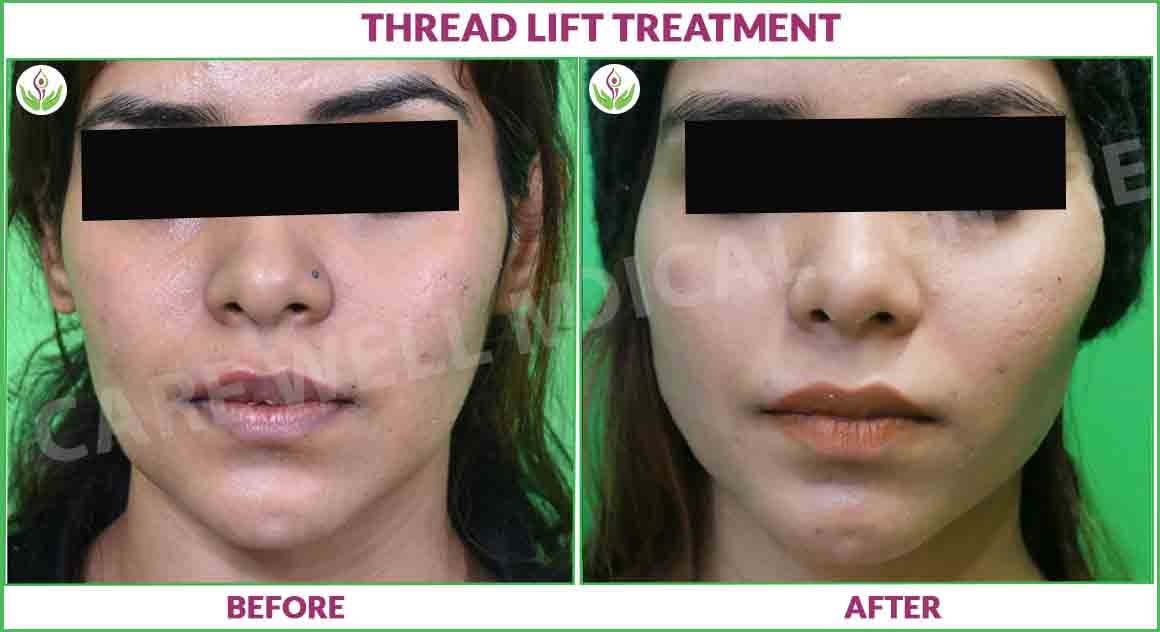 Thread lift before and after result photo