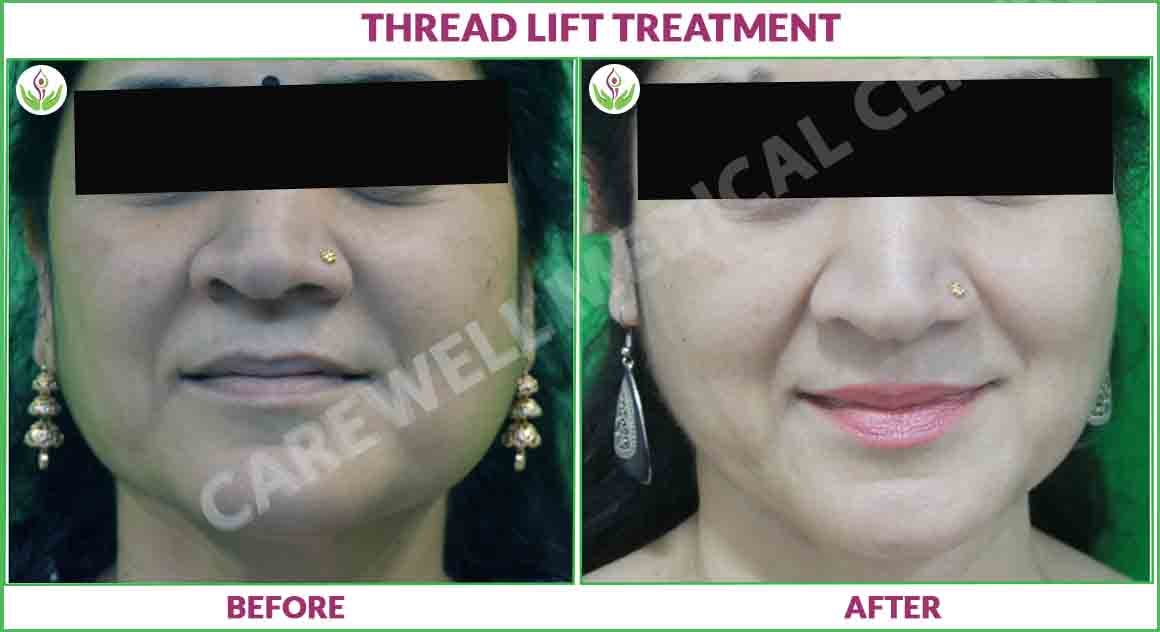 Thread lift before and after result photo