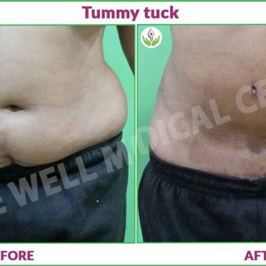 Tummy Tuck Before and After Image