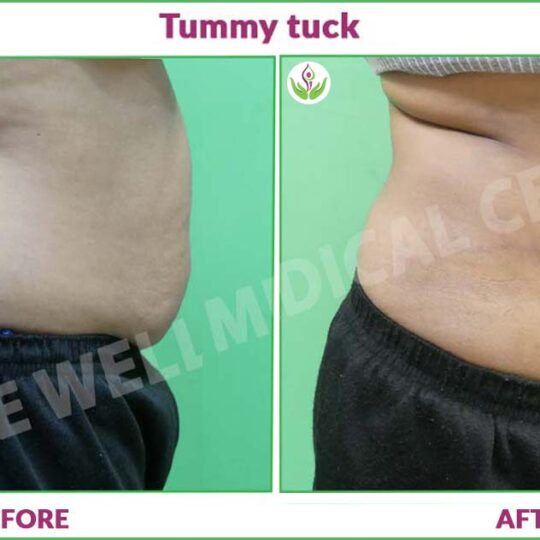 Tummy Tuck Before and After Photo