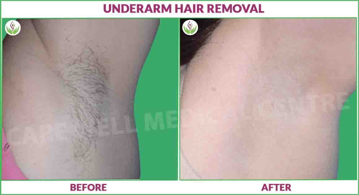 underarms laser hair reducation before and after image