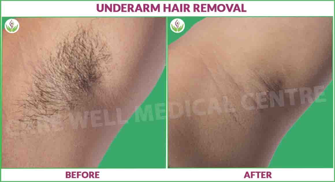 underarms laser hair reducation before and after photo