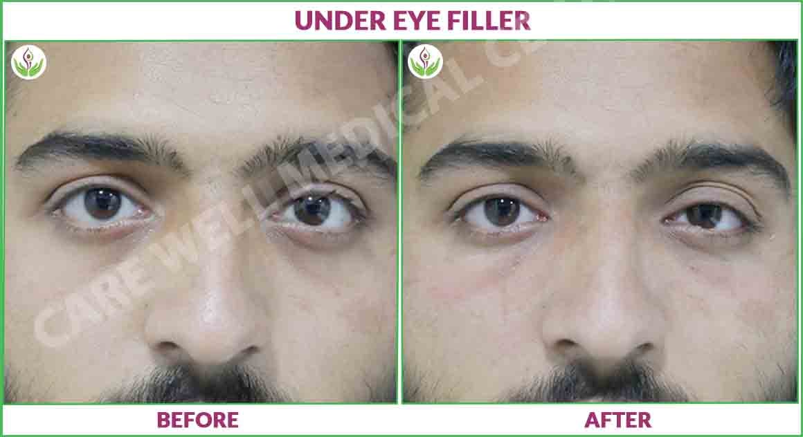 Under eye fillers before and after photo 1