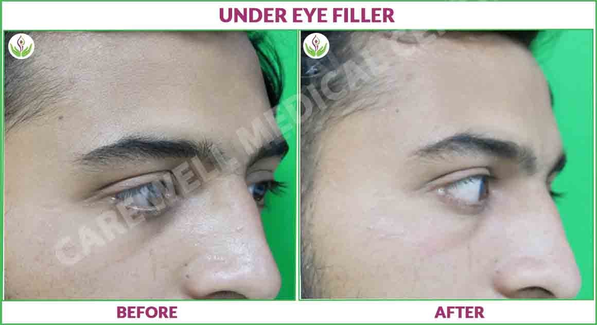 Under eye fillers before and after photo