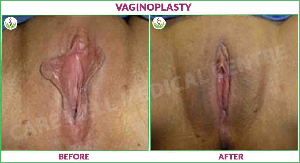 vaginoplasty before and after photo