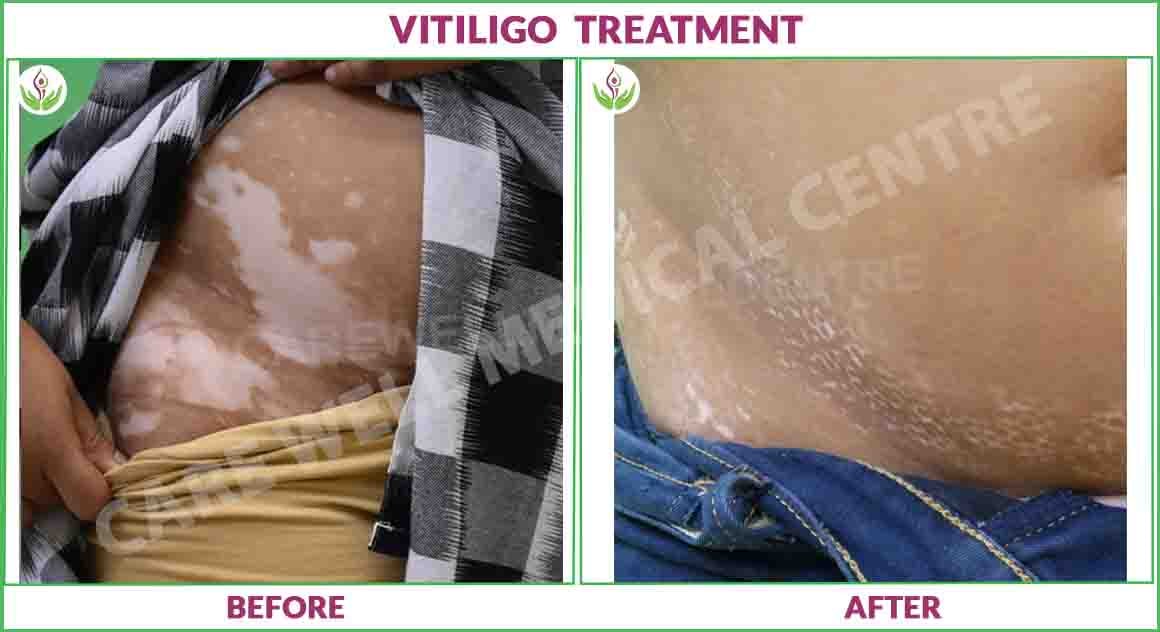 vitiligo treatment before and after photo