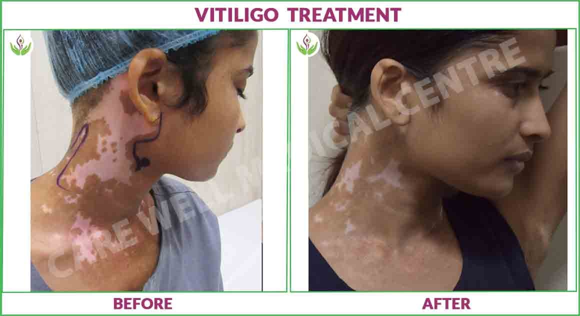 vitiligo treatment before and after photo 1