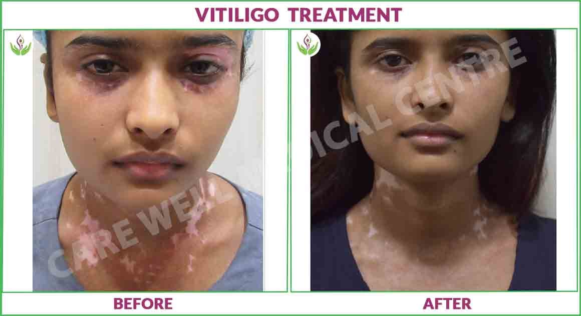 vitiligo treatment before and after photo 2