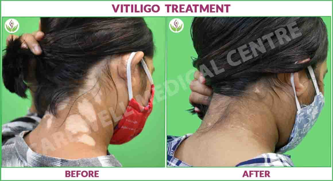 vitiligo treatment before and after photo 3