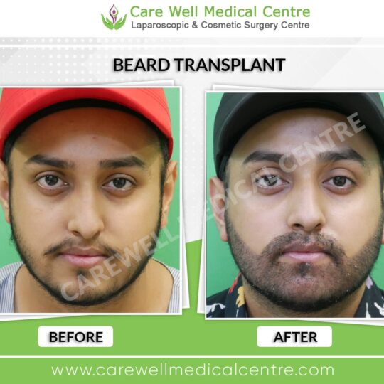 Beard transplant before and after results in Delhi showing natural, fuller hair growth.