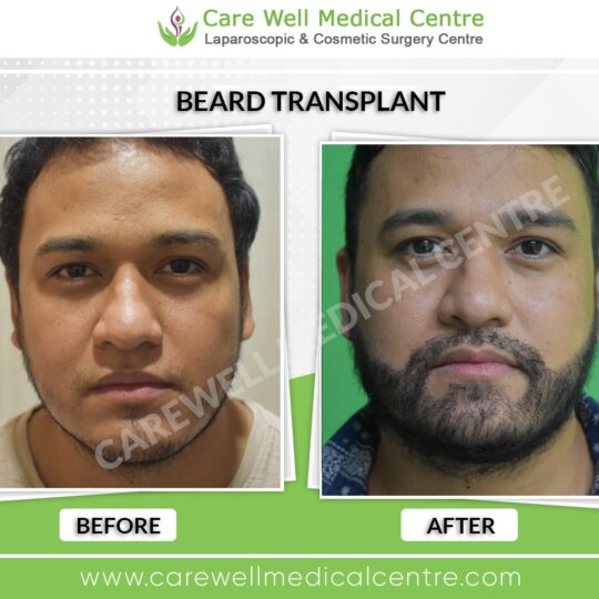 Before and after beard transplant results in Delhi demonstrating successful hair restoration.