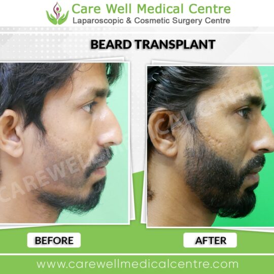 Before and after results of a beard transplant in Delhi showing natural hair restoration.