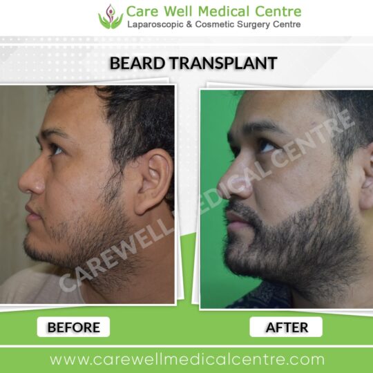 Beard transplant before and after results in Delhi showcasing natural hair restoration.