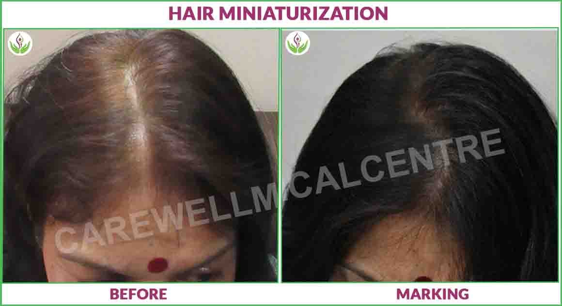 Hair Miniaturization before and after result