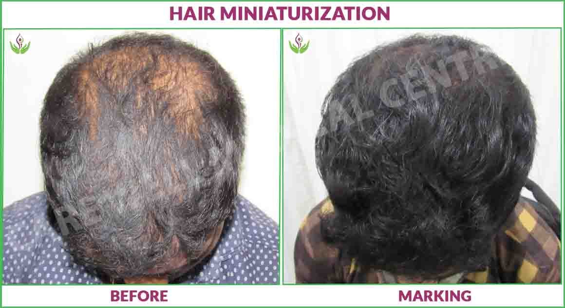 Hair Miniaturization before and after results