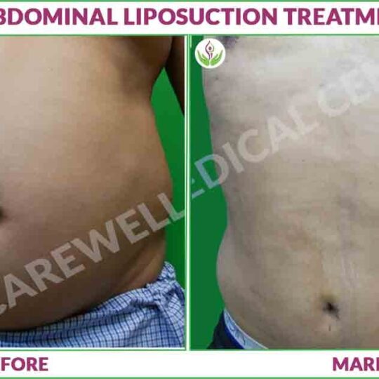 abdominal liposuction treatment before and afte results