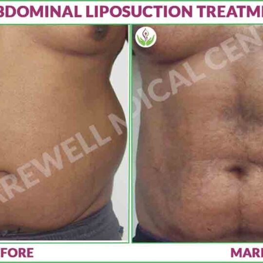 abdominal liposuction treatment before and after photo in Delhi