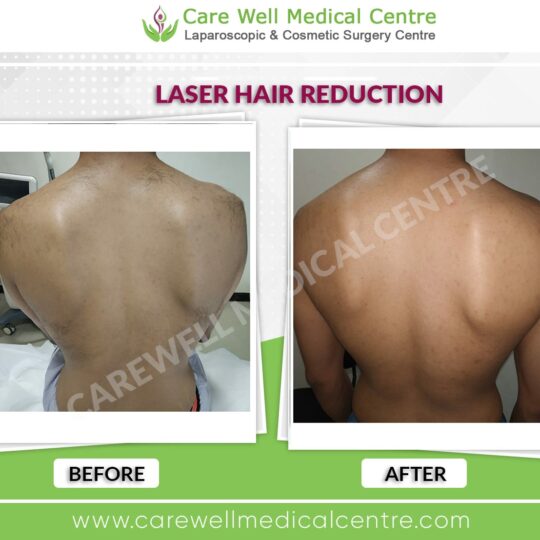 back laser hair reduction before and after result