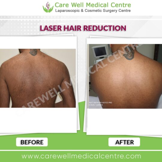 back laser hair reduction before and after results